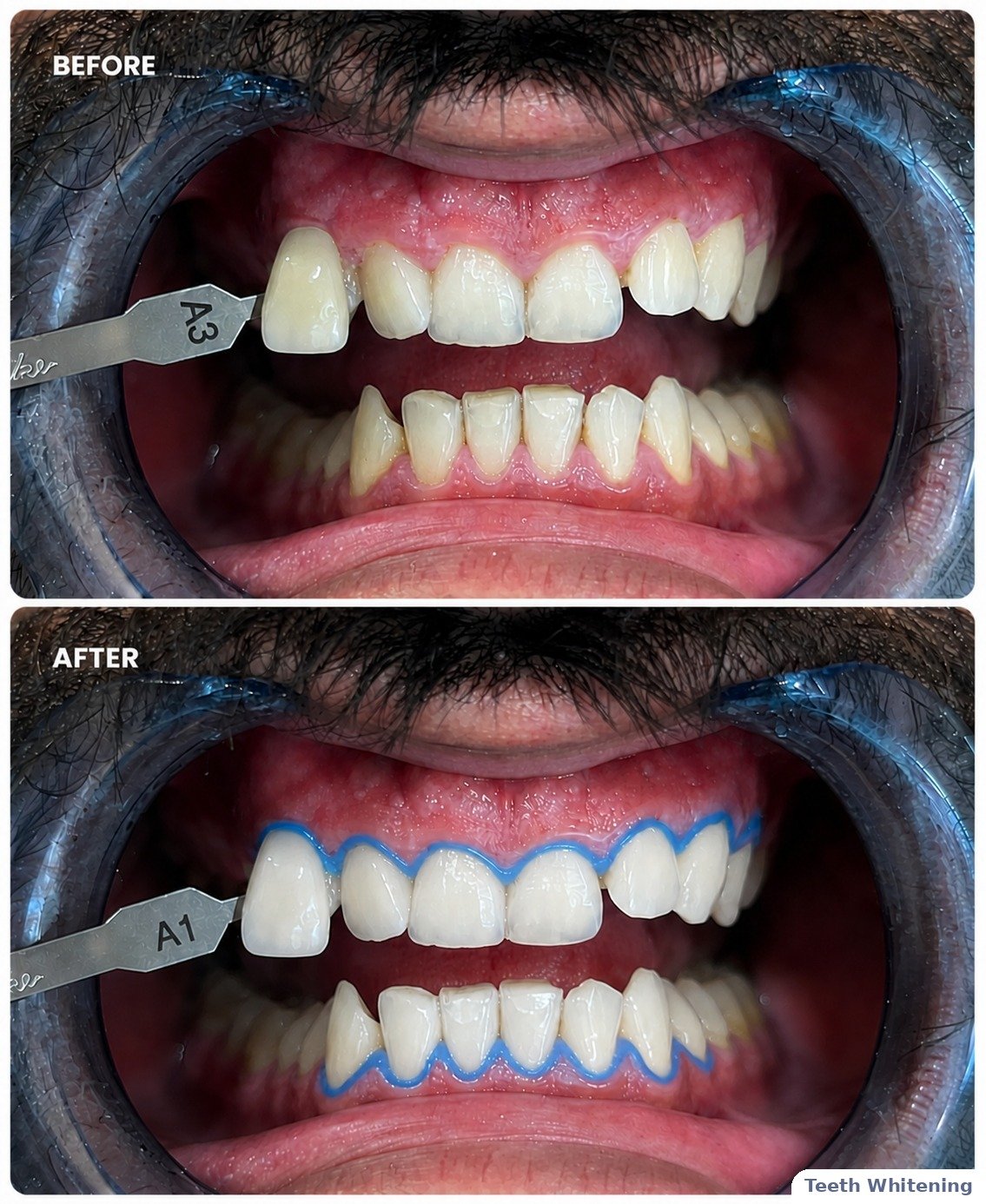 Teeth whitening case