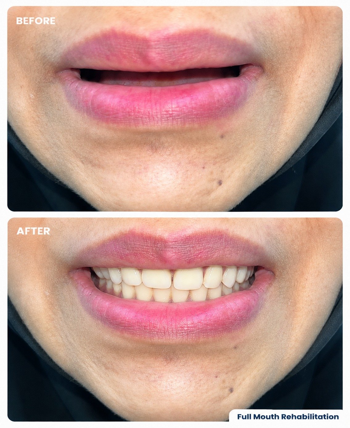 Full mouth rehabilitation case